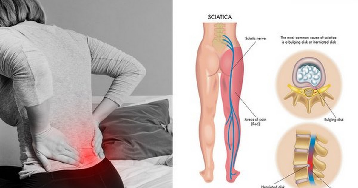 What-Vitamin-Can-Relieve-Sciatic-Nerve-Pain-Naturally?